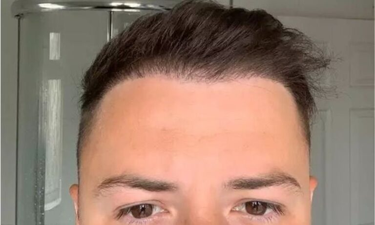 Τουρκία: 26χρονος Άγγλος πήγε για μεταμόσχευση μαλλιών και έμεινε…χωρίς μαλλιά (pics)