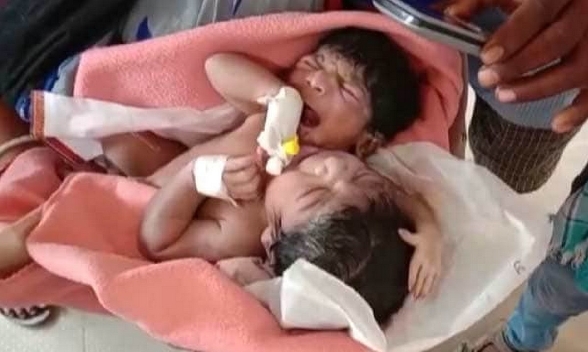 Ινδία: Γεννήθηκε μωράκι με δύο κεφάλια και τρία χέρια (vid)