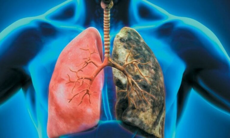 Καρκίνος του πνεύμονα: Βρέθηκε τρόπος για να ανιχνεύεται 1 χρόνο νωρίτερα!