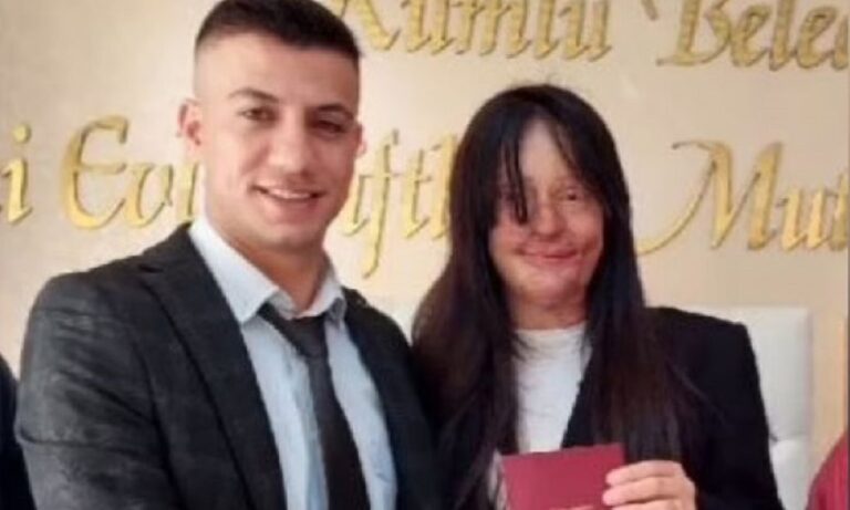 Τουρκία: Παντρεύτηκε τον άντρα που την παραμόρφωσε με οξύ