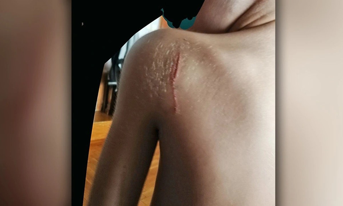 Bullying: Γροθιά στο στομάχι η μαρτυρία του 11χρονου που τον χαράκωσαν – «Με απειλούν – Τα παιδιά είναι ανεξέλεγκτα»