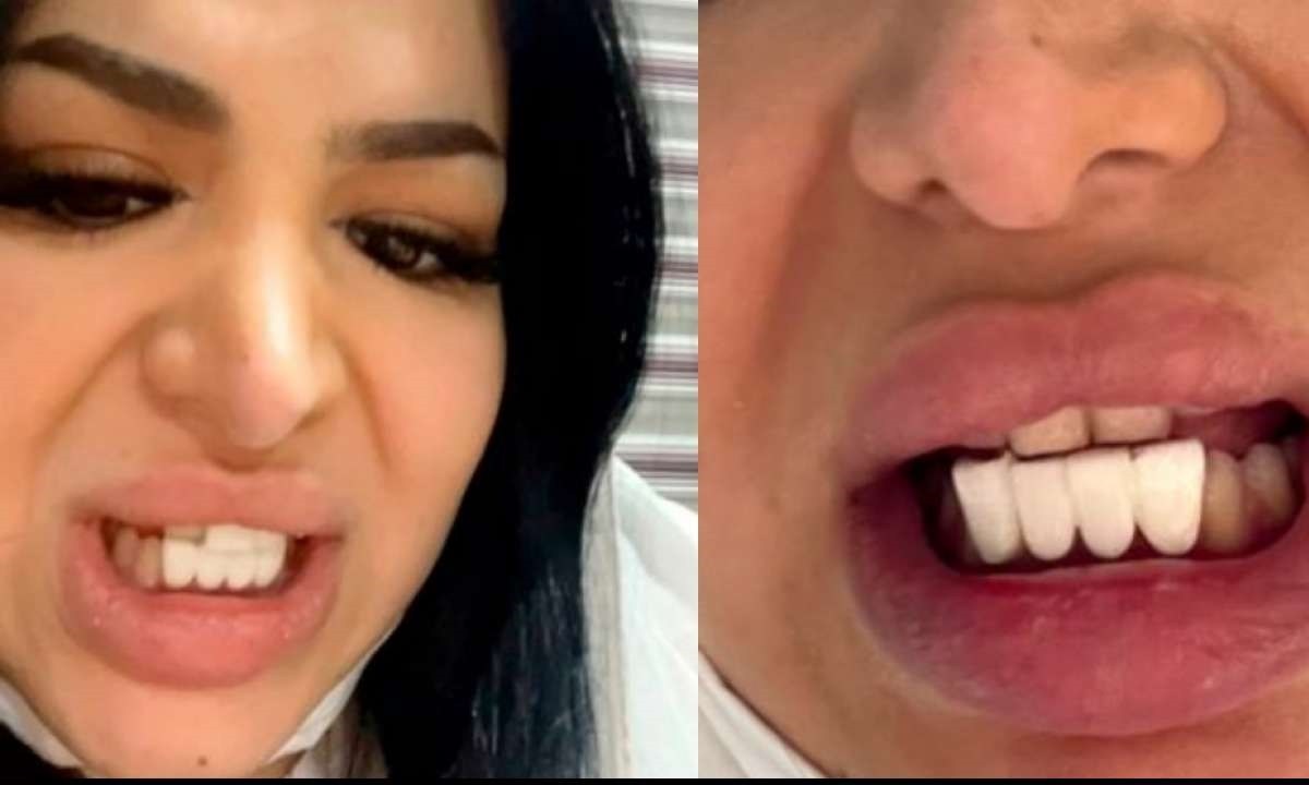 Ιράν: 26χρονη Αποφάσισε να φτιάξει τα δόντια της στις διακοπές της και κατέληξαν να θυμίζουν... πλήκτρα πιάνου!