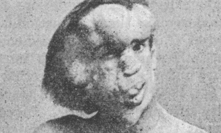 Υπήρξε πράγματι ο άνθρωπος-ελέφαντας; Η συγκλονιστική ιστορία του Τζόζεφ Μέρικ