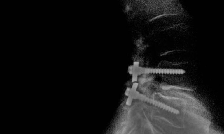 Του έβαλαν ένα κανονικό κατσαβίδι στη σπονδυλική στήλη. Τι αποζημίωση πήρε η οικογένειά του