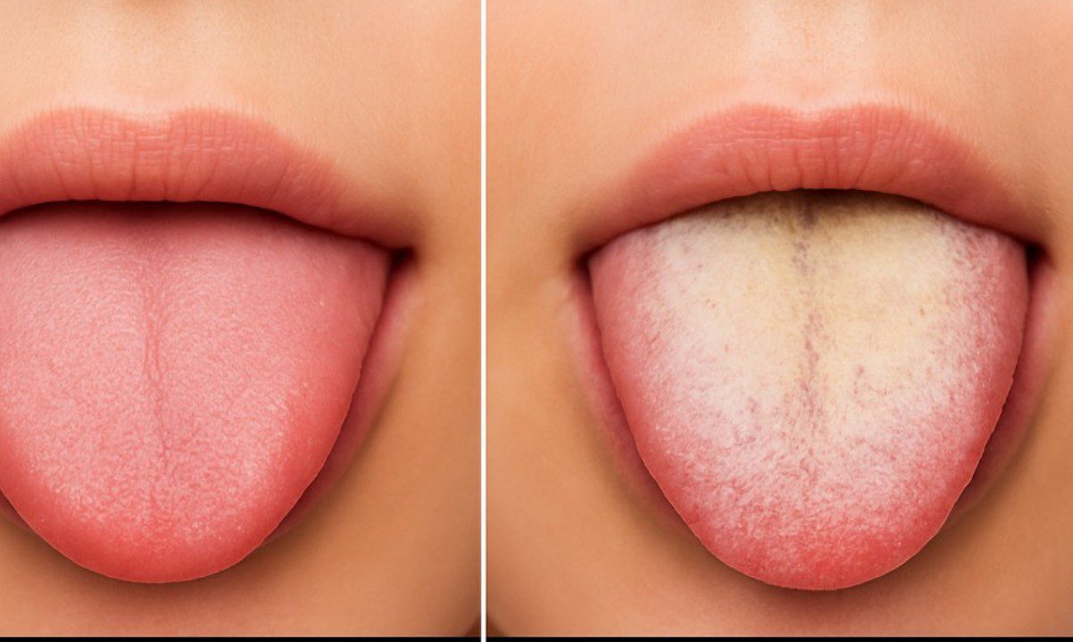 Η γλώσσα… σου μιλάει: 11 σημάδια στην στοματική κοιλότητα που μπορεί να προειδοποιούν για προβλήματα υγείας!