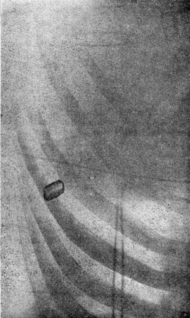 Σφαίρα σφηνωμένη στο πλευρό του Θεόδωρου Ρούζβελτ μετά την απόπειρα δολοφονίας.